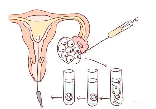 试管婴儿胚胎着床需要几日？